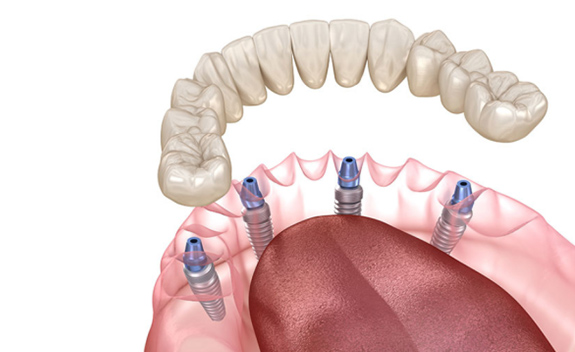 All-on-4（4本のインプラント）