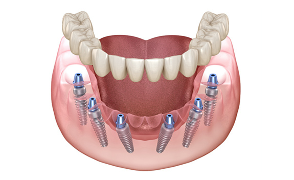 All-on-6（6本のインプラント）