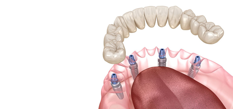 All-on-4（4本のインプラント）