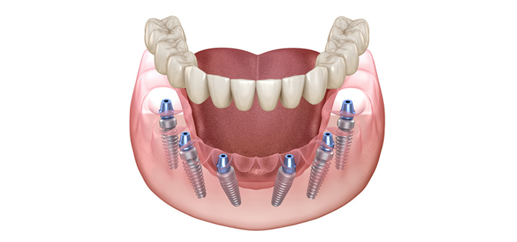 All-on-6（6本のインプラント）